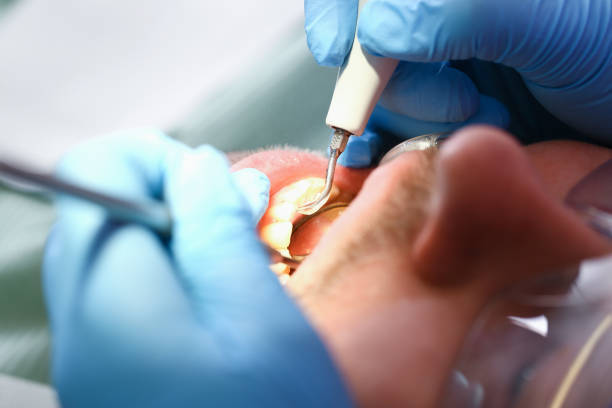 Best Emergency Wisdom Teeth Removal in Coon Rapids, IA